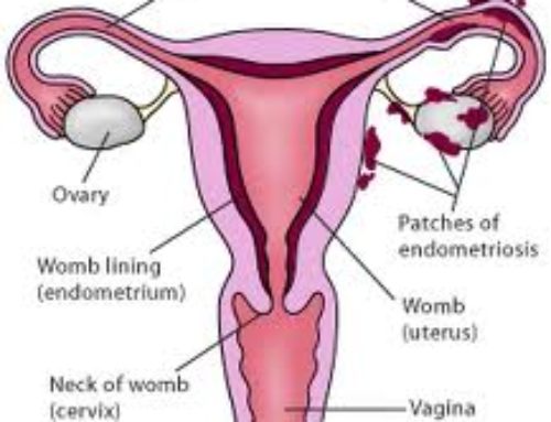 Lembar Informasi untuk Pasien dan Keluarga  Kista Endometriosis